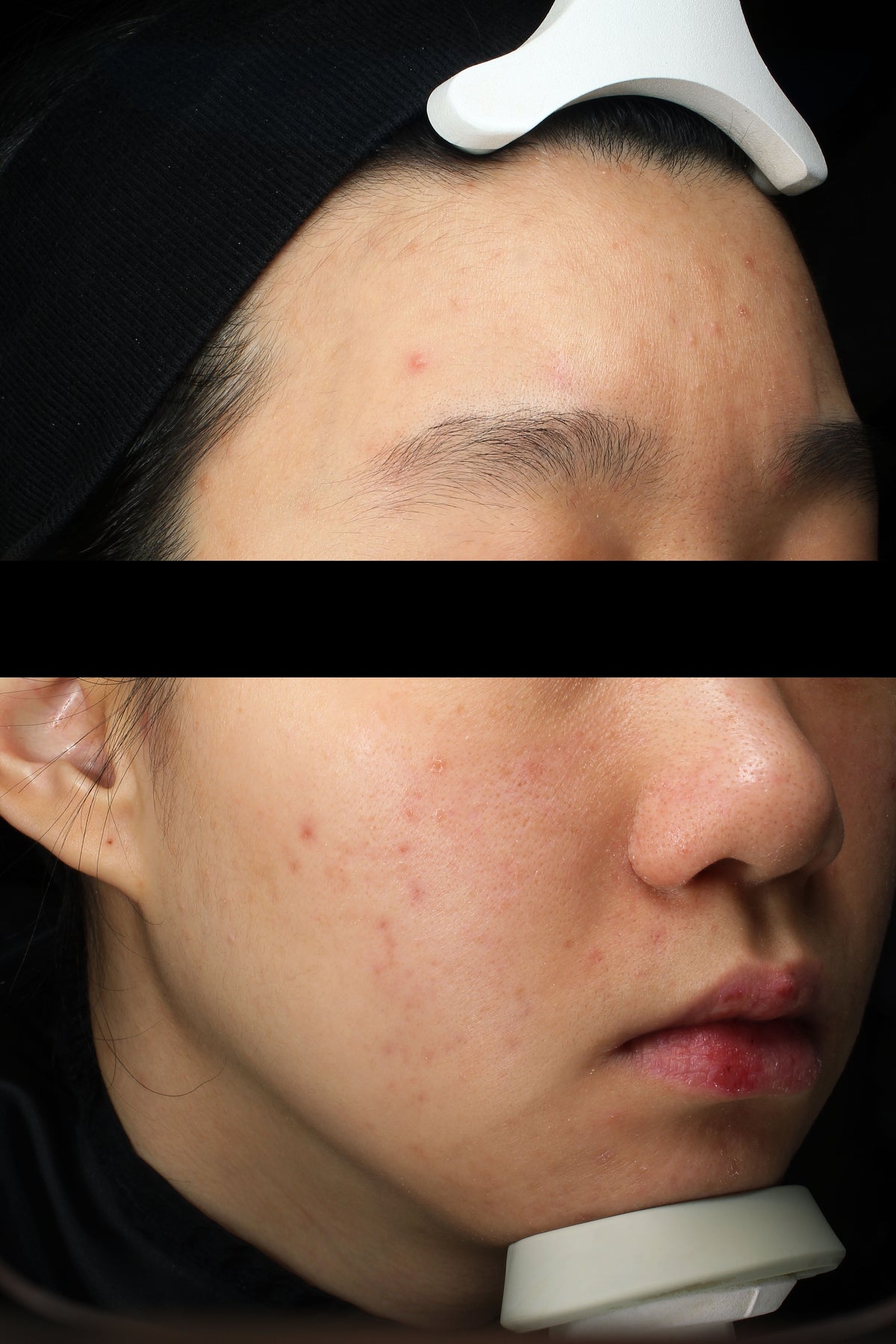 After 4 weeks of using Golden Jojoba Micro-bubble Cleanser: close-ups of the forehead and cheek