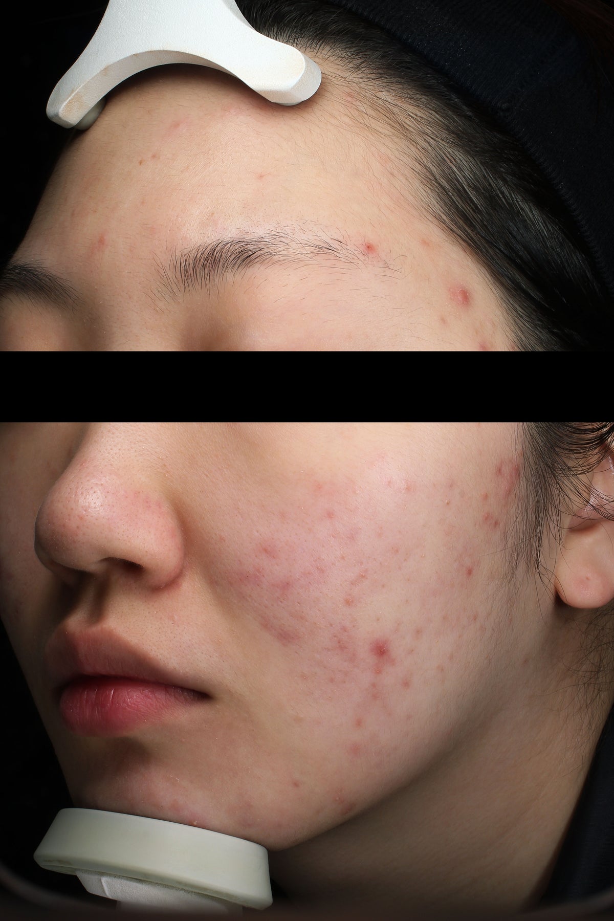 Antes de usar Blue Calming Cleansing Milk: primeros planos de la frente y la mejilla