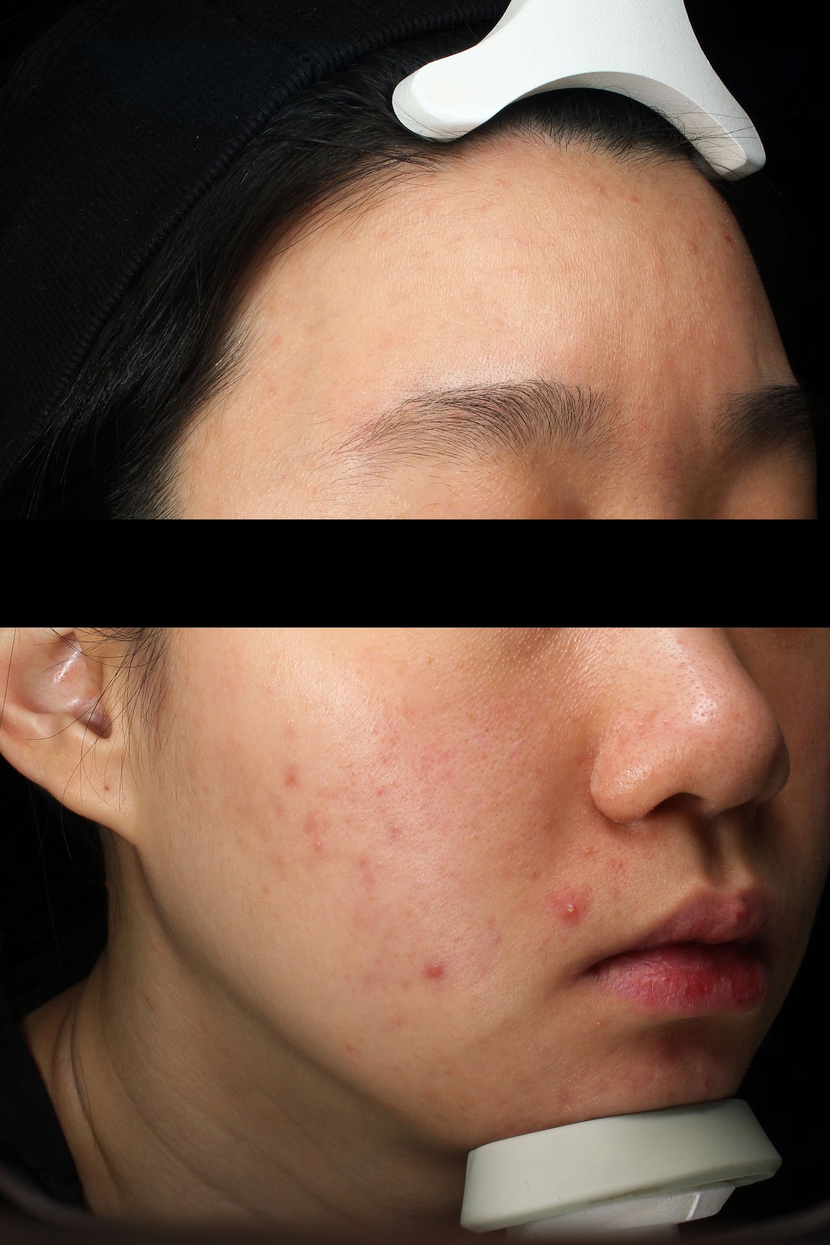 Before using Golden Jojoba Micro-bubble Cleanser: close-ups of the forehead and cheek