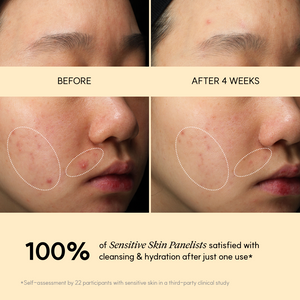 Before and after 4 weeks of Golden Jojoba Micro-bubble Cleanser on sensitive skin