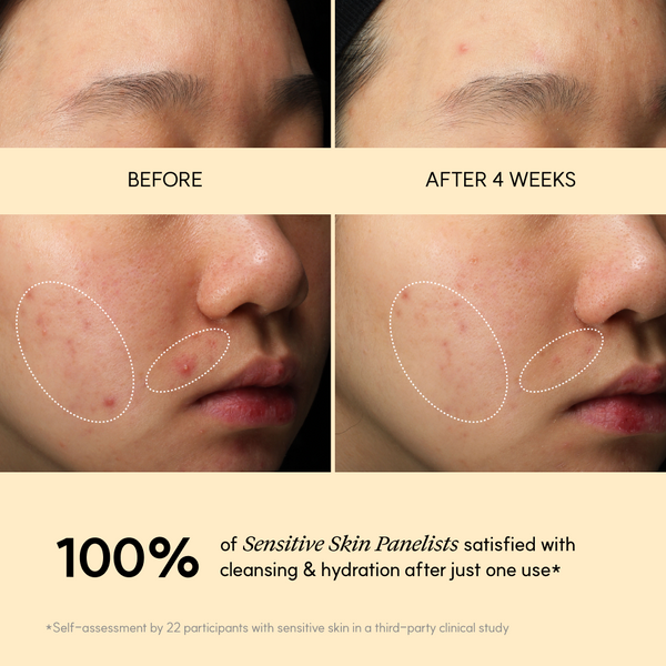 Before and after 4 weeks of Golden Jojoba Micro-bubble Cleanser on sensitive skin