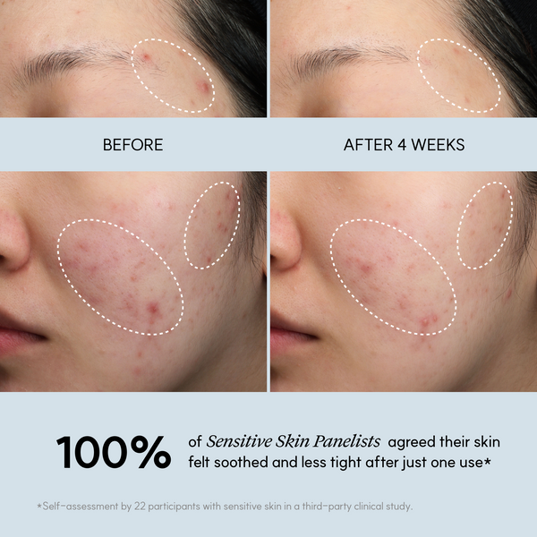 Antes y después de 4 semanas de uso de Blue Calming Cleansing Milk: reducción del enrojecimiento visible en piel sensible