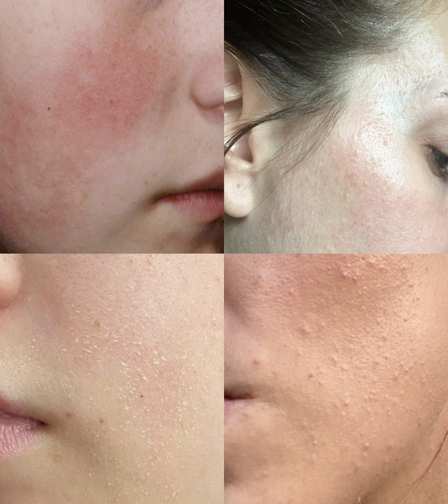 Cuatro fotografías de cerca de la piel del rostro con enrojecimiento y textura irregular